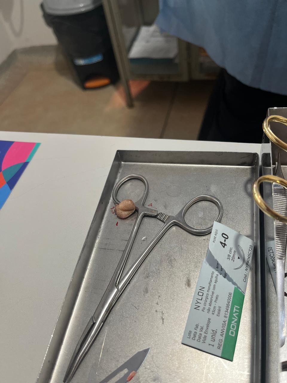 Pequenas cirurgias ambulatoriais são realizadas com sucesso em Lagoa da Confusão
