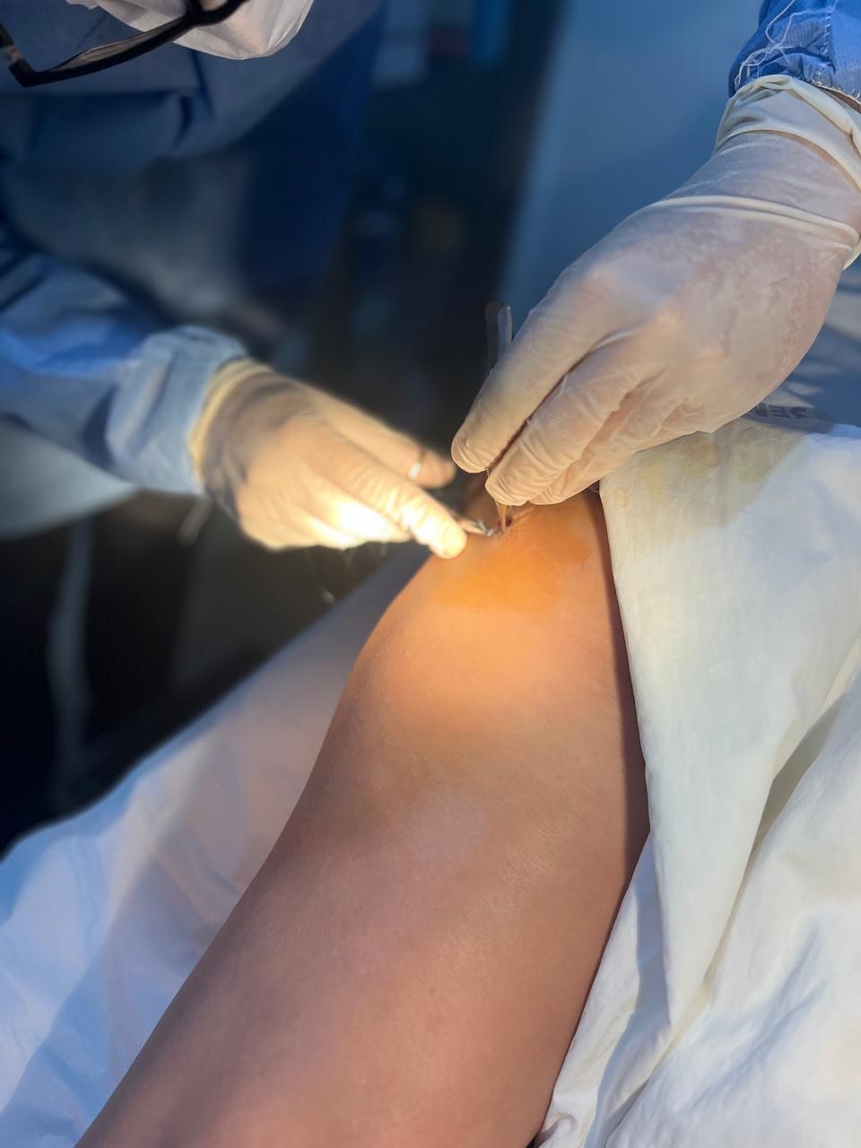 Pequenas cirurgias ambulatoriais são realizadas com sucesso em Lagoa da Confusão