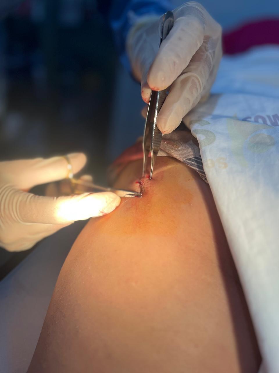 Pequenas cirurgias ambulatoriais são realizadas com sucesso em Lagoa da Confusão